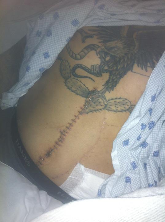 ABDUL NEVAREZ SURGERY STOMACH SCAR