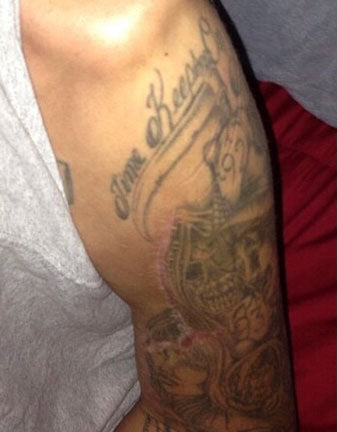 ABDUL NEVAREZ LEFT ARM SCARS